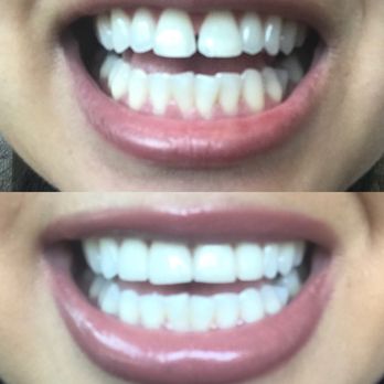 DentalWorks - Thanks! Love my new smile - General Dentistry Near Me - Rock Hill, South Carolina DentalWorks - Thanks! Love my new smile - General Dentistry Near Me - Rock Hill, South Carolina