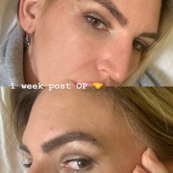 Sword and Dauer Hair Restoration - Before and after eyebrow transplant with Dr. Meshkin in Newport Beach. Charged me 2000. Full eyebrow is around 4000.