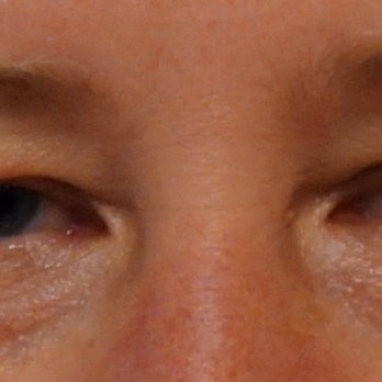 Jeffrey Joseph, MD - Before - Cosmetic Surgeons Near Me - Newport Beach, California