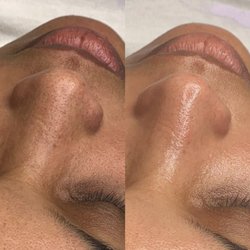 Clear pores!