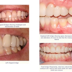 Anne B Filler, DMD, MAGD - Patient had two bridges that were constructed to replace her missing lateral incisors, original bridges showed to be too larg...
