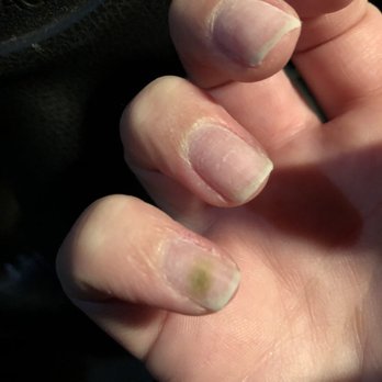 Magic Nail Lash - DO NOT GO HERE. I got a bacterial infection from getting acrylics from Louis! They are not properly sanitizing equipment or applying nails. - Nail Salons Near Me - Lone Tree, Colorado Magic Nail Lash - DO NOT GO HERE. I got a bacterial infection from getting acrylics from Louis! They are not properly sanitizing equipment or applying nails. - Nail Salons Near Me - Lone Tree, Colorado