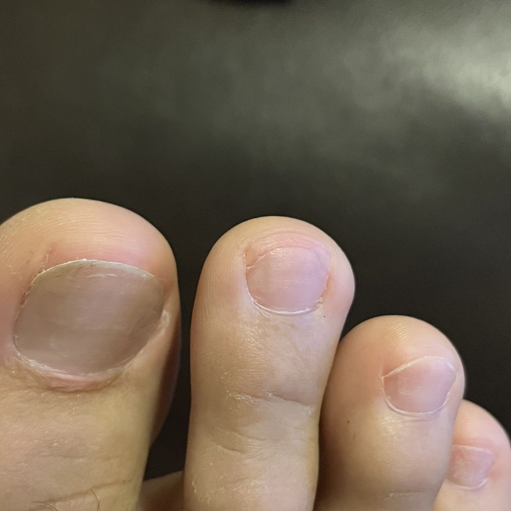 BF's nails cut way too short. Now at risk for ingrowns. BF's nails cut way too short. Now at risk for ingrowns.