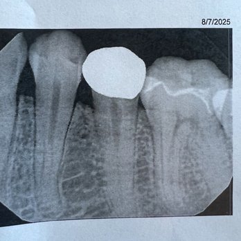 Westview Dental Care - X-ray showing the unnatural shape of the tooth, no natural anatomy or shape - General Dentistry Near Me - Los Angeles, California Westview Dental Care - X-ray showing the unnatural shape of the tooth, no natural anatomy or shape - General Dentistry Near Me - Los Angeles, California