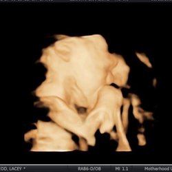 Motherhood Ultrasound - The quality of the 3D Ultrasound pictures I got from "Motherhood Ultrasound"