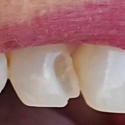 Palmetto Dental Center - Failed front filling