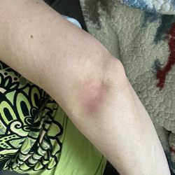 Dr. Leon Ortiz Centro Ortopédico - El morete me duró casi 3 semanas y el dolor persiste