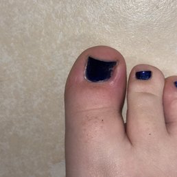 You can see the infection and the toe next to it obviously isn't cut straight. You can see the infection and the toe next to it obviously isn't cut straight.