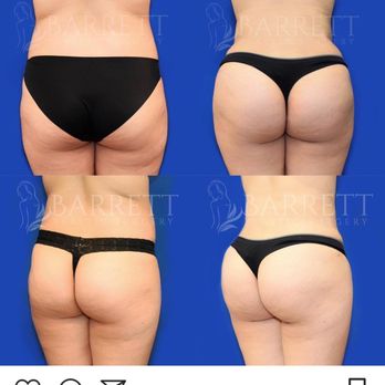 Barrett Plastic Surgery - Cosmetic Surgeons Near Me - Beverly Hills, California
