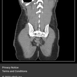 Vincent Cifello, MD - Colon Rectal - Image of rectal intussuception herniating into prostate and adjacent structures