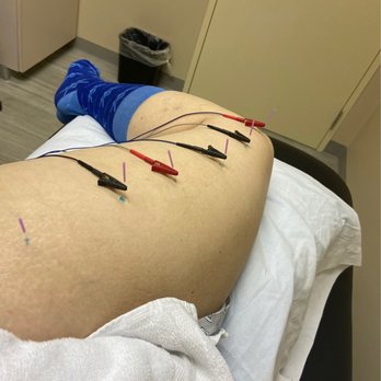 X Factor Physical Therapy & Wellness Center - Lots of needles - Physical Therapy Near Me - Hurst, Texas X Factor Physical Therapy & Wellness Center - Lots of needles - Physical Therapy Near Me - Hurst, Texas