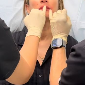 Knox Dermatology - Bellafill treatment in lips - Dermatologists Near Me - Dallas, Texas Knox Dermatology - Bellafill treatment in lips - Dermatologists Near Me - Dallas, Texas