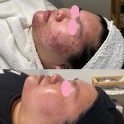 Clear Skin Solutions