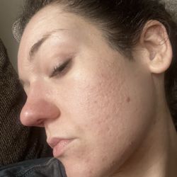Ann Arbor Plastic Surgery - Ann Arbor - Pre chemical peel