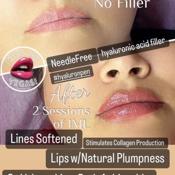 Kiss Me Vegas - Before and After with 1mL = 2 sessions (8/24 & 9/7) - Skin Care Near Me
