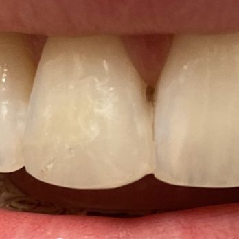Black Mountain Dental Care - One of the sloppiest fixes I had -- dr glued the filling to the neighboring tooth , leaving me unable to floss teeth. - General Dentistry Near Me - Cave Creek, Arizona Black Mountain Dental Care - One of the sloppiest fixes I had -- dr glued the filling to the neighboring tooth , leaving me unable to floss teeth. - General Dentistry Near Me - Cave Creek, Arizona