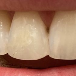 Black Mountain Dental Care - One of the sloppiest fixes I had -- dr glued the filling to the neighboring tooth , leaving me unable to floss teeth.
