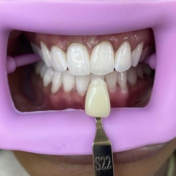 Bora Teeth Whitening - Before & After - Teeth Whitening Near Me