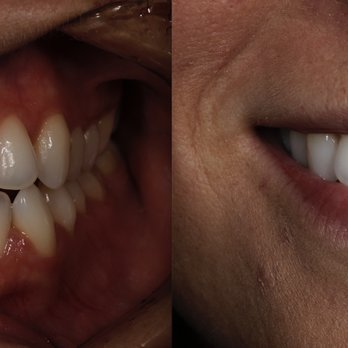California Smile Dental Studio - Before and after. Everything is 100% the same except for my two front teeth yet they all appear whiter and healthier.. magic. - Cosmetic Dentists Near Me - Gardena, California California Smile Dental Studio - Before and after. Everything is 100% the same except for my two front teeth yet they all appear whiter and healthier.. magic. - Cosmetic Dentists Near Me - Gardena, California