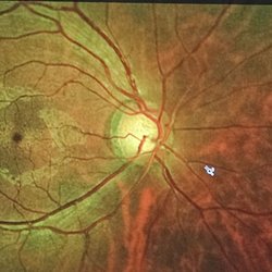 Costco Vision Center - My right eye