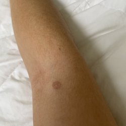 Agape - Hole punch biopsy - 2 years after