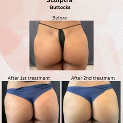Great Neck Medical Spa - Sculptra butt lift by Dr Deborah Marciano