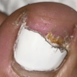 You can see the fungus inside my toe nail and toe was getting dry as you can see You can see the fungus inside my toe nail and toe was getting dry as you can see