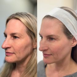 Skiin Blackhawk - Botox for pre-jowls and IPL