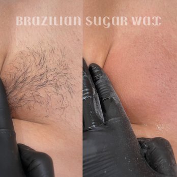 Bes Beauty - before and after brazilian sugaring wax - Teeth Whitening Near Me Bes Beauty - before and after brazilian sugaring wax - Teeth Whitening Near Me