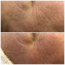 CPMedSpa Laser & Skin - Two sessions of Microneedling 6 weeks apart. Top photo before, bottom photo 6 weeks after second session.  @ CPMedSpa Laser & Skin