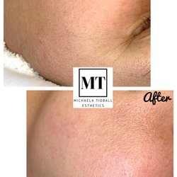 Michaela Tidball Esthetics - Dermaplane Facial