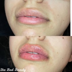 She Bad Beauty - 1 ML of volume lip filler with the Hyaluron pen