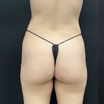 Vitality Medical Center - Before, day of surgery, dr said I had enough fat to transfer - Medical Spas Near Me - Glendale, California