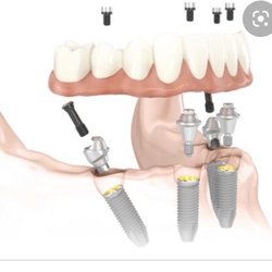 Tim Silegy, OMFS, DDS - All on 4 implants