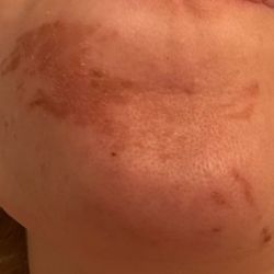 New Looks Threading Salon - My face is all burned and blistered from the wax.