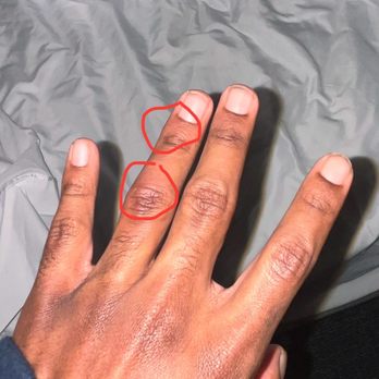 Spark by Hilton Bakersfield Central - My son's hands, so glad he felt the stinging! - Hotels Near Me - Bakersfield, California Spark by Hilton Bakersfield Central - My son's hands, so glad he felt the stinging! - Hotels Near Me - Bakersfield, California