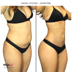 Skin 'n Skinnier - Awake Lipo360 + SkinnyBBL