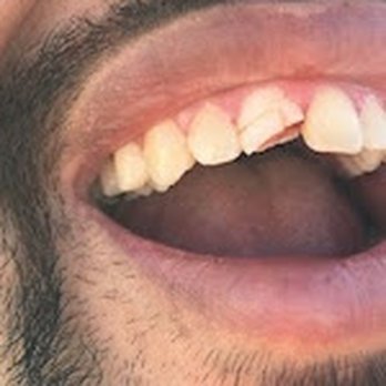 Harry C Brown, DDS - Before. - Cosmetic Dentists Near Me - Claremont, California