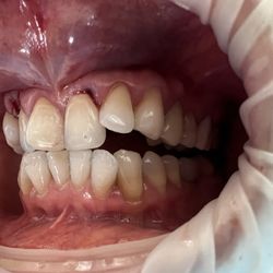 Danny T Nguyen, DDS - Berryessa Dental - Shifted inward can't bite down