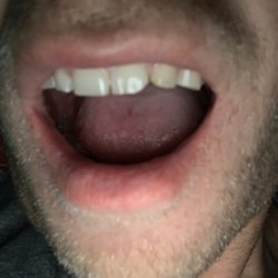 Wallace Group Dentistry - This is what a fixed chipped tooth looks like when you visit this dentist!