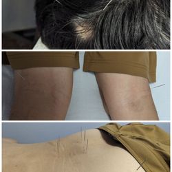 Acupuncture & Herbs of Lu - Dr. Lu is very skilled at acupuncture. I've been to many places and