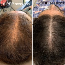 Before and after 3 PRP sessions with Dr. Karhade. Before and after 3 PRP sessions with Dr. Karhade.