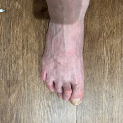 MedicinEvolution - Hammer Toe(s)
