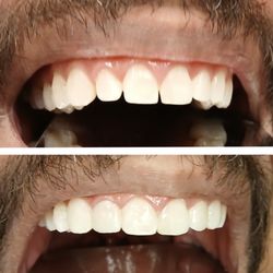 JK Family Dental - Same day veneers. No prep! No shaving down teeth