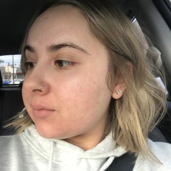 Exceptional Dermatology Care - After my 3rd and final treatment :) - Dermatologists Near Me - Fullerton, California Exceptional Dermatology Care - After my 3rd and final treatment :) - Dermatologists Near Me - Fullerton, California