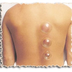 Paul Barbara, Mac, Lac - Skagit Whole Health Center - Cupping is a method of applying acupressure by creating a vacuum next to the patient's skin.