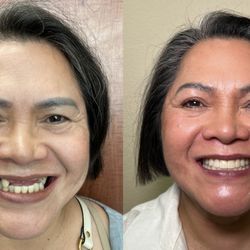 El Dorado Family Dental - Before and after Full arch upper and lower dental implatns