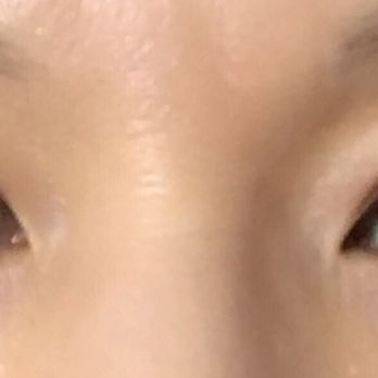Shine Cosmetic Surgery - After double eyelid surgery - Cosmetic Surgeons Near Me - West Covina, California