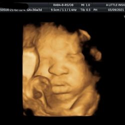 A Little Insight 3d 4d 5d Ultrasound 299 Photos 292 Reviews Ultrasound Imaging Centers 190 S Orchard Ave Vacaville Ca Phone Number