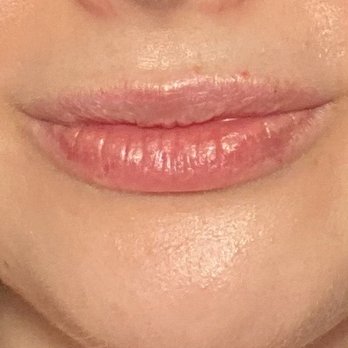 LaserAway - After 1/2 syringe of Juvaderm - Medical Spas Near Me - Pasadena, California